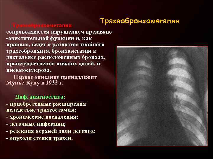 Трахеобронхомегалия сопровождается нарушением дренажно -очистительной функции и, как правило, ведет к развитию гнойного трахеобронхита,