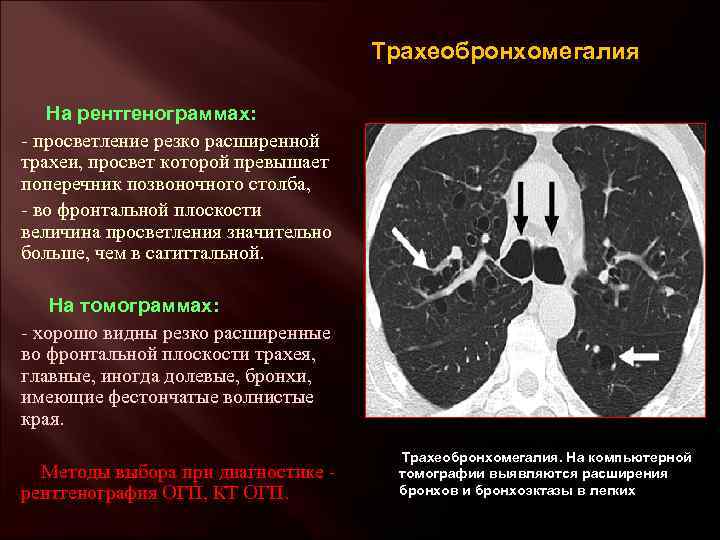 Трахеобронхомегалия На рентгенограммах: - просветление резко расширенной трахеи, просвет которой превышает поперечник позвоночного столба,