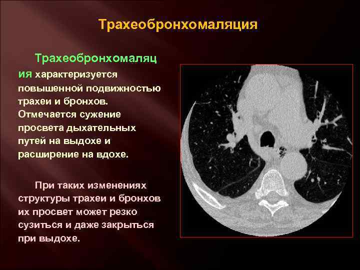 Трахеобронхомаляция Трахеобронхомаляц ия характеризуется повышенной подвижностью трахеи и бронхов. Отмечается сужение просвета дыхательных путей