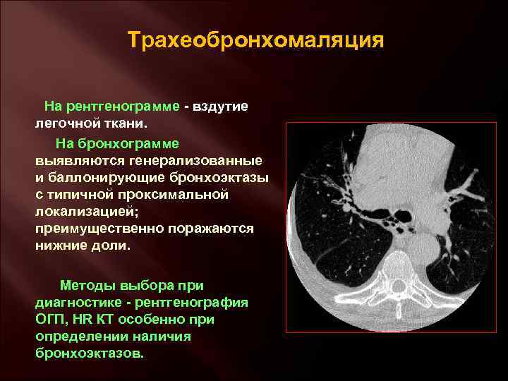 Трахеобронхомаляция На рентгенограмме - вздутие легочной ткани. На бронхограмме выявляются генерализованные и баллонирующие бронхоэктазы