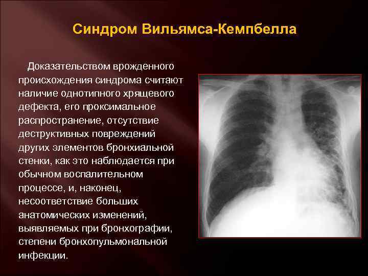 Синдром Вильямса-Кемпбелла Доказательством врожденного происхождения синдрома считают наличие однотипного хрящевого дефекта, его проксимальное распространение,