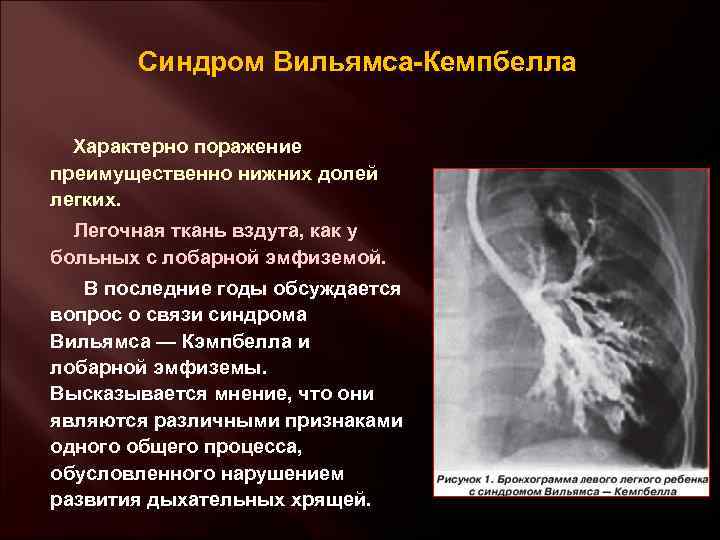 Синдром Вильямса-Кемпбелла Характерно поражение преимущественно нижних долей легких. Легочная ткань вздута, как у больных