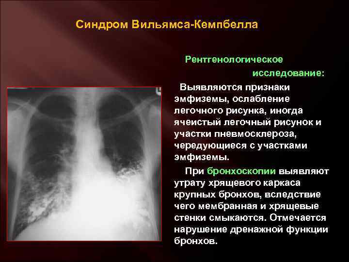 Синдром Вильямса-Кемпбелла Рентгенологическое исследование: Выявляются признаки эмфиземы, ослабление легочного рисунка, иногда ячеистый легочный рисунок