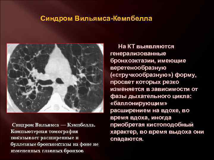 Синдром Вильямса-Кемпбелла На КТ выявляются генерализованные бронхоэктазии, имеющие веретенообразную ( «стручкообразную» ) форму, просвет