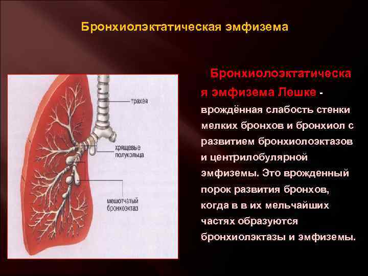 Бронхиолэктатическая эмфизема Бронхиолоэктатическа я эмфизема Лешке - врождённая слабость стенки мелких бронхов и бронхиол