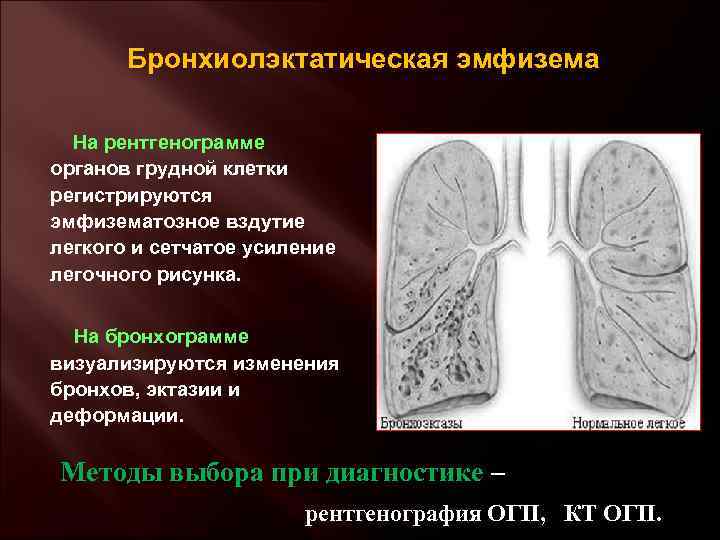 Бронхиолэктатическая эмфизема На рентгенограмме органов грудной клетки регистрируются эмфизематозное вздутие легкого и сетчатое усиление