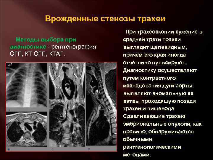 Врожденные стенозы трахеи Методы выбора при диагностике - рентгенография ОГП, КТАГ. При трахеоскопии сужение