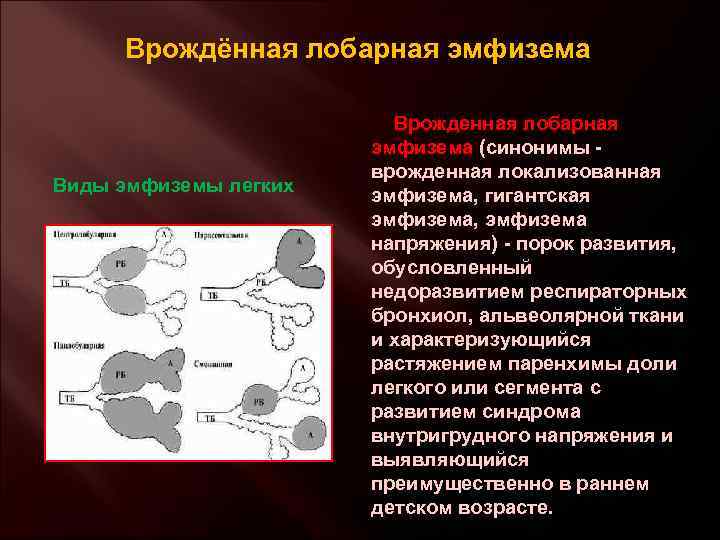 Врождённая лобарная эмфизема Виды эмфиземы легких Врожденная лобарная эмфизема (синонимы - врожденная локализованная эмфизема,