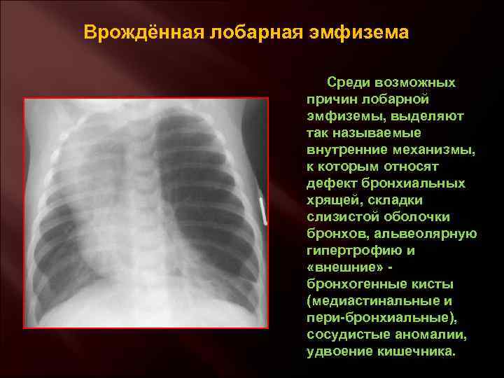 Врождённая лобарная эмфизема Среди возможных причин лобарной эмфиземы, выделяют так называемые внутренние механизмы, к