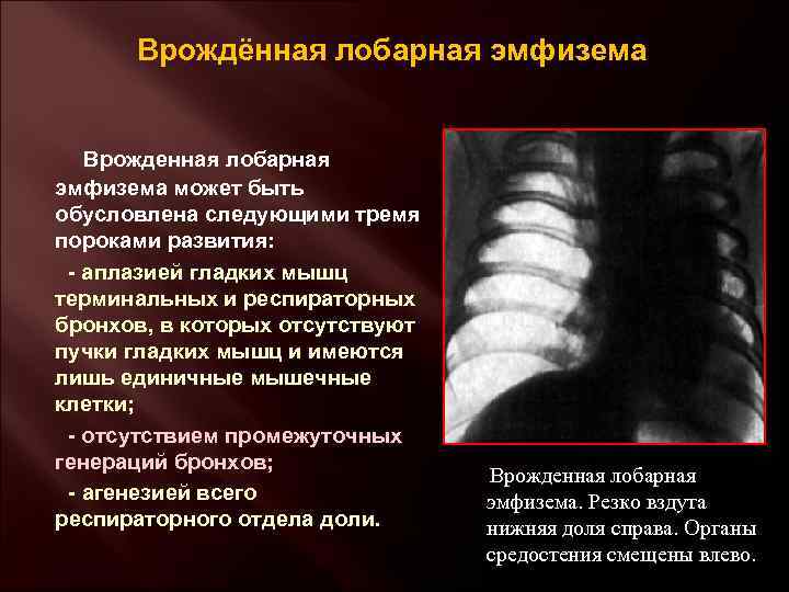 Врожденная лобарная эмфизема клиника рентгенологическая картина принципы лечения