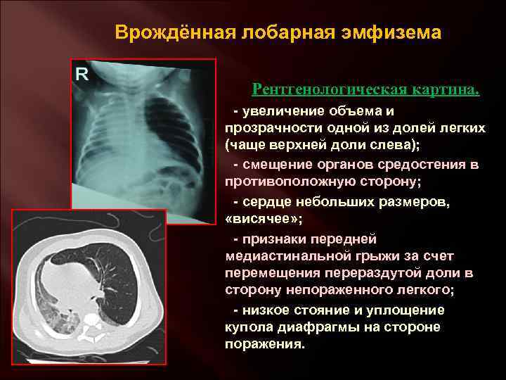 Врождённая лобарная эмфизема Рентгенологическая картина. - увеличение объема и прозрачности одной из долей легких