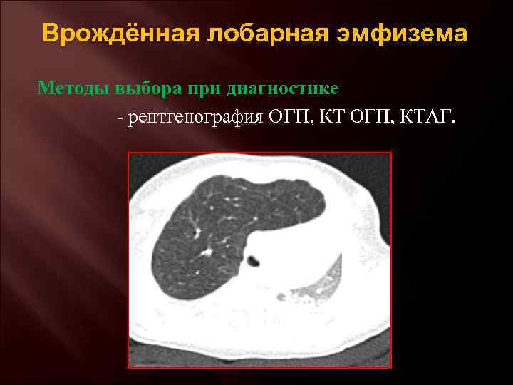 Врождённая лобарная эмфизема Методы выбора при диагностике - рентгенография ОГП, КТАГ. 