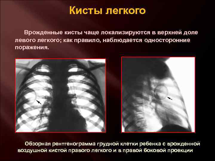 Кисты легкого Врожденные кисты чаще локализируются в верхней доле левого легкого; как правило, наблюдается