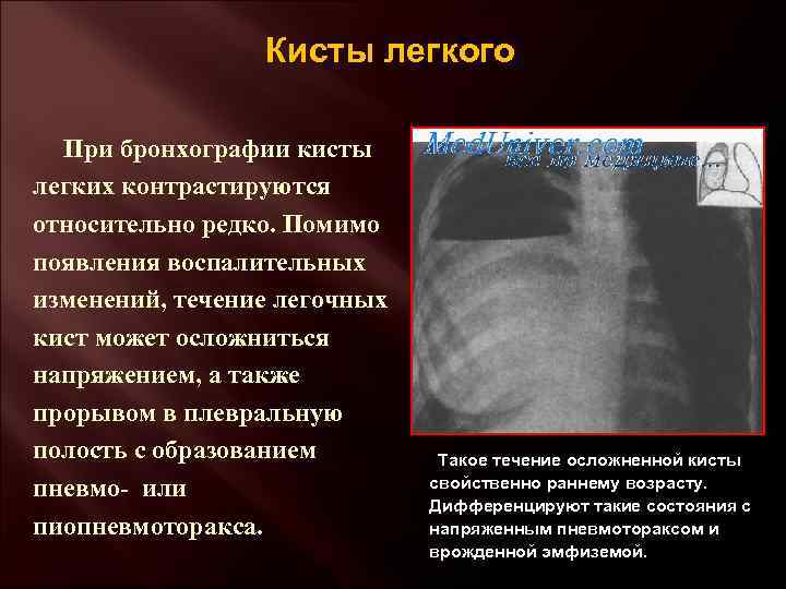 Кисты легкого При бронхографии кисты легких контрастируются относительно редко. Помимо появления воспалительных изменений, течение