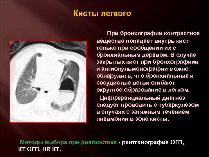 Кисты легкого При бронхографии контрастное вещество попадает внутрь кист только при сообщении их с