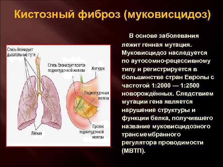 Кистозный фиброз (муковисцидоз) В основе заболевания лежит генная мутация. Муковисцидоз наследуется по аутосомно-рецессивному типу