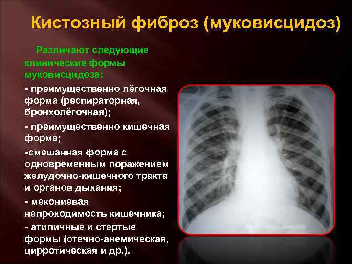 Муковисцидоз рентгенологическая картина