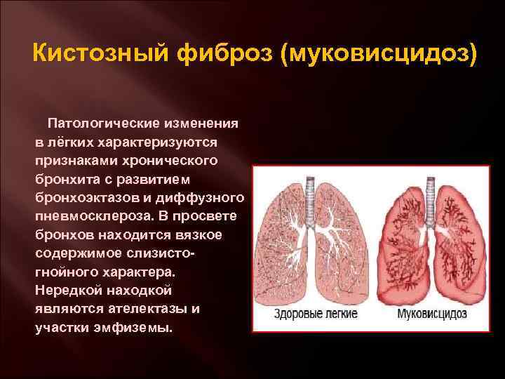 Кистозный фиброз (муковисцидоз) Патологические изменения в лёгких характеризуются признаками хронического бронхита с развитием бронхоэктазов