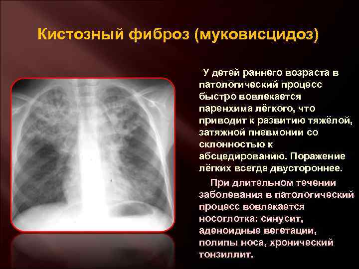 Кистозный фиброз (муковисцидоз) У детей раннего возраста в патологический процесс быстро вовлекается паренхима лёгкого,