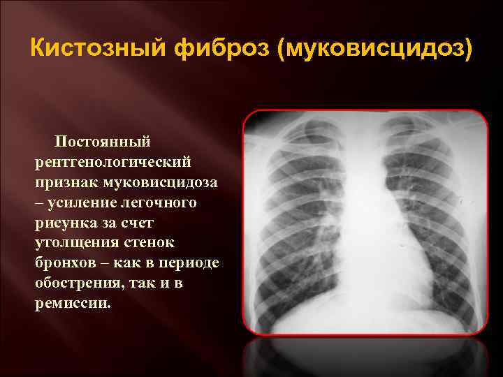 Кистозный фиброз (муковисцидоз) Постоянный рентгенологический признак муковисцидоза – усиление легочного рисунка за счет утолщения