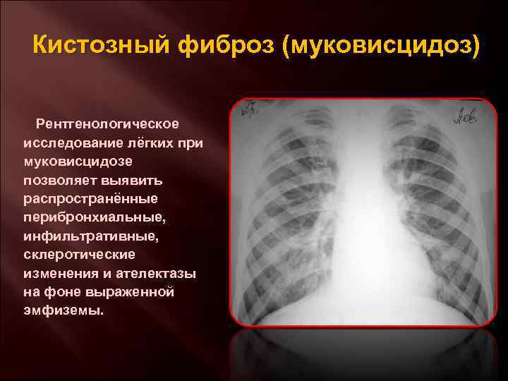 Кистозный фиброз (муковисцидоз) Рентгенологическое исследование лёгких при муковисцидозе позволяет выявить распространённые перибронхиальные, инфильтративные, склеротические