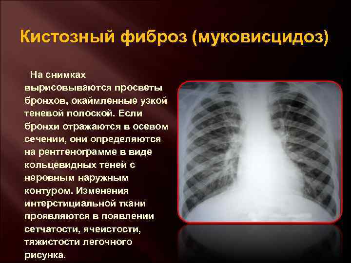 Кистозный фиброз (муковисцидоз) На снимках вырисовываются просветы бронхов, окаймленные узкой теневой полоской. Если бронхи