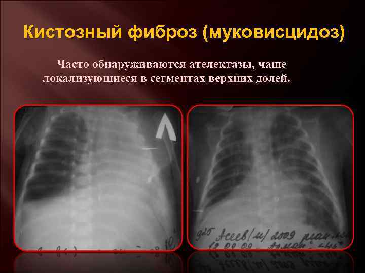 Кистозный фиброз (муковисцидоз) Часто обнаруживаются ателектазы, чаще локализующиеся в сегментах верхних долей. 