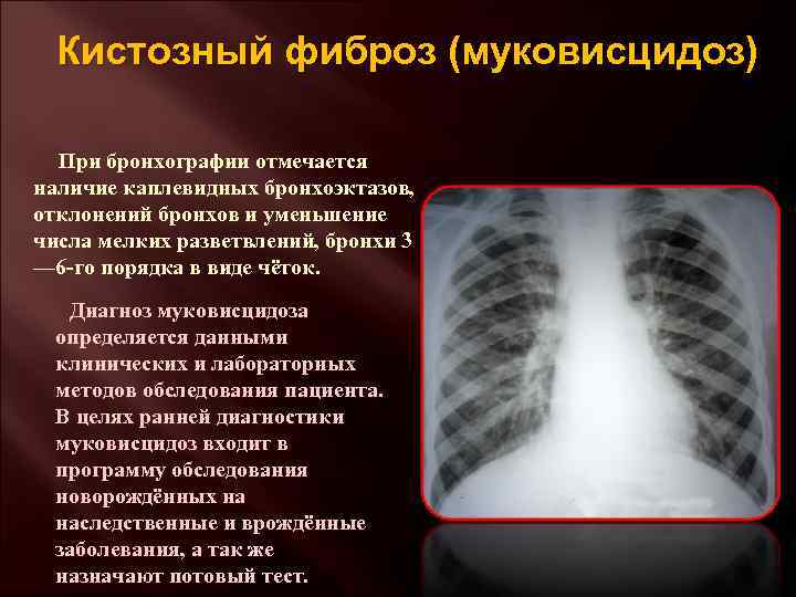 Кистозный фиброз (муковисцидоз) При бронхографии отмечается наличие каплевидных бронхоэктазов, отклонений бронхов и уменьшение числа