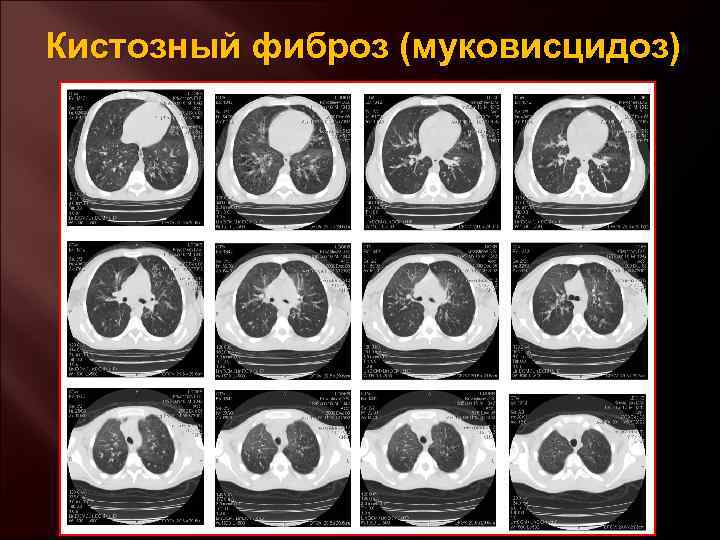 Кистозный фиброз (муковисцидоз) 