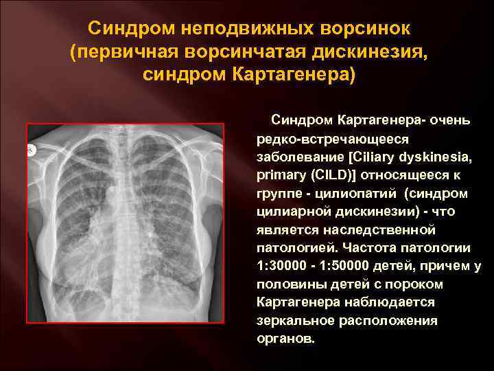 Синдром неподвижных ворсинок (первичная ворсинчатая дискинезия, синдром Картагенера) Синдром Картагенера- очень редко-встречающееся заболевание [Ciliary