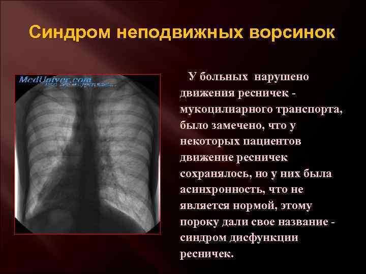 Синдром неподвижных ворсинок У больных нарушено движения ресничек - мукоцилиарного транспорта, было замечено, что