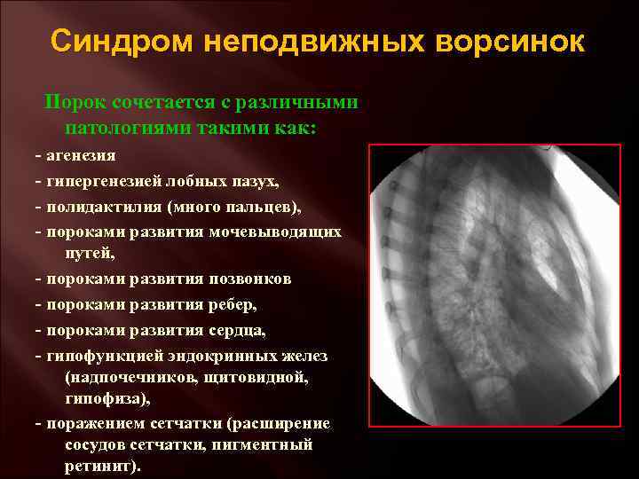 Синдром неподвижных ворсинок Порок сочетается с различными патологиями такими как: - агенезия - гипергенезией