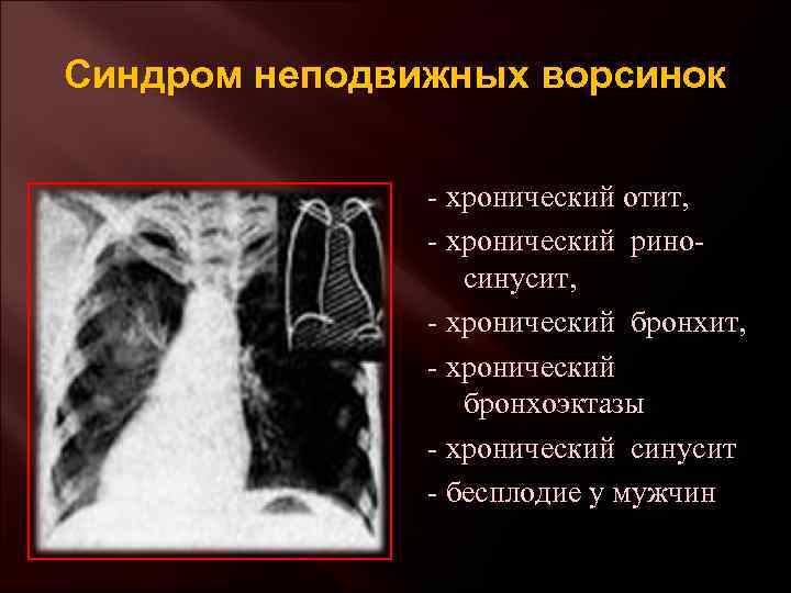 Синдром неподвижных ворсинок - хронический отит, - хронический риносинусит, - хронический бронхит, - хронический