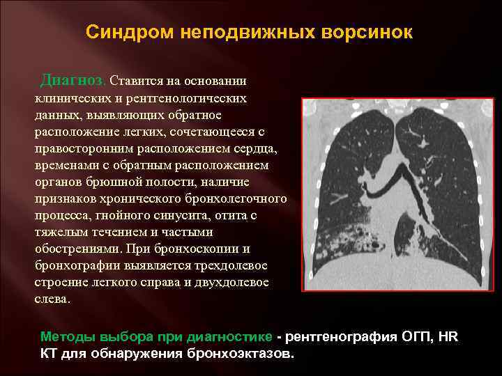 Синдром неподвижных ворсинок Диагноз. Ставится на основании клинических и рентгенологических данных, выявляющих обратное расположение