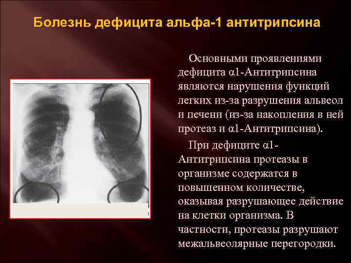 Болезнь дефицита альфа-1 антитрипсина Основными проявлениями дефицита α 1 -Антитрипсина являются нарушения функций легких