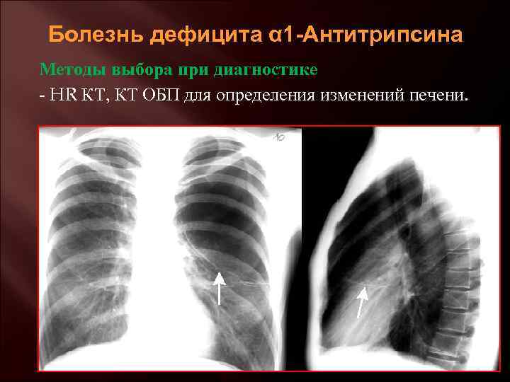 Болезнь дефицита α 1 -Антитрипсина Методы выбора при диагностике - HR КТ, КТ ОБП