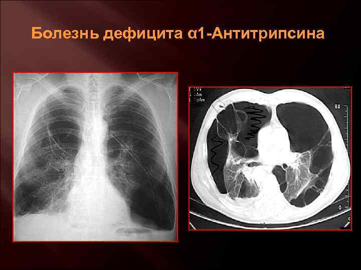 При аномалии эбштейна легочный рисунок