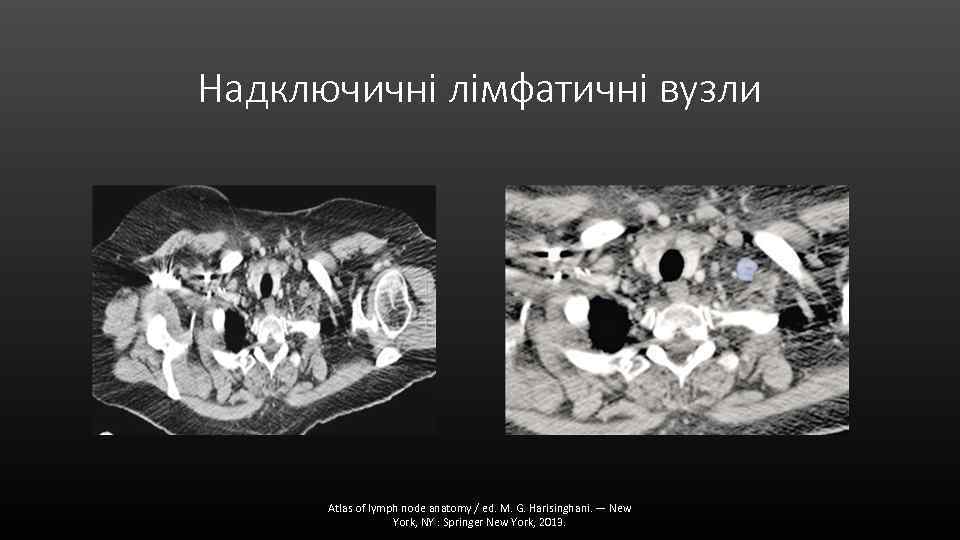 Надключичні лімфатичні вузли Atlas of lymph node anatomy / ed. M. G. Harisinghani. —