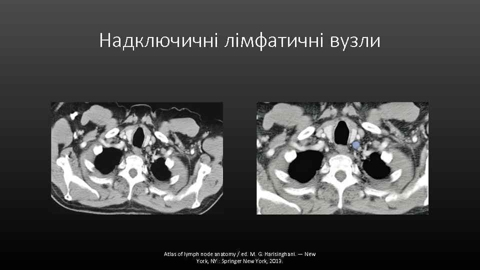 Надключичні лімфатичні вузли Atlas of lymph node anatomy / ed. M. G. Harisinghani. —