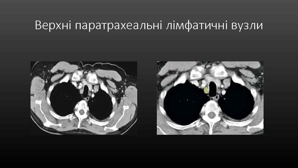 Верхні паратрахеальні лімфатичні вузли 