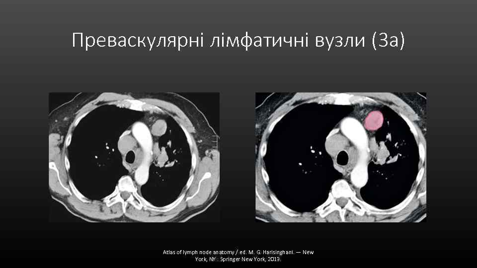 Преваскулярні лімфатичні вузли (3 а) Atlas of lymph node anatomy / ed. M. G.