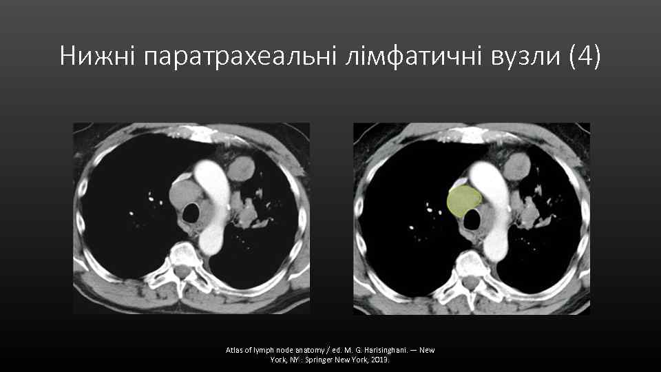 Нижні паратрахеальні лімфатичні вузли (4) Atlas of lymph node anatomy / ed. M. G.