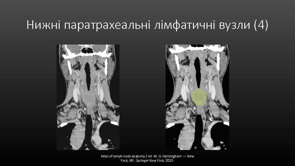 Нижні паратрахеальні лімфатичні вузли (4) Atlas of lymph node anatomy / ed. M. G.