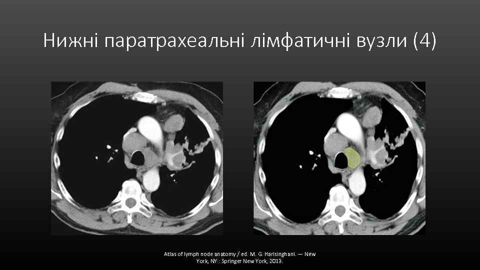 Нижні паратрахеальні лімфатичні вузли (4) Atlas of lymph node anatomy / ed. M. G.