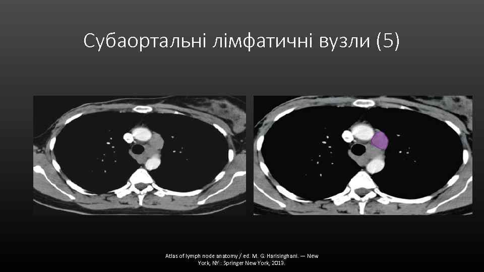 Субаортальні лімфатичні вузли (5) Atlas of lymph node anatomy / ed. M. G. Harisinghani.