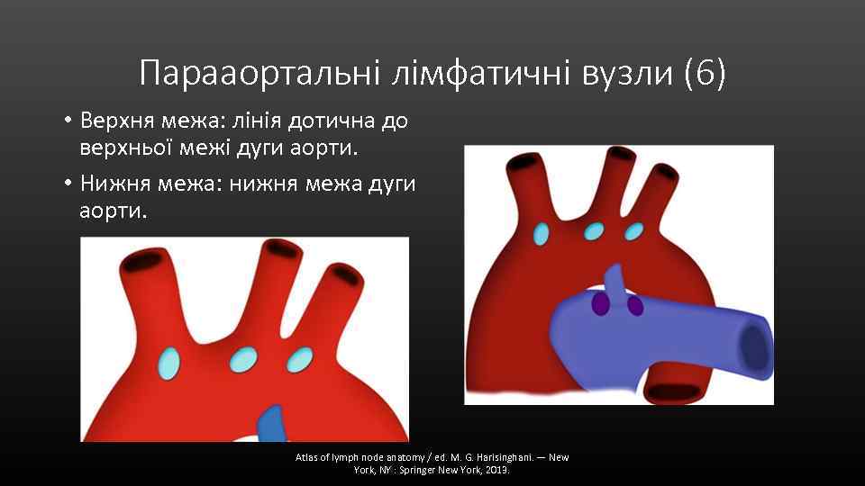 Парааортальні лімфатичні вузли (6) • Верхня межа: лінія дотична до верхньої межі дуги аорти.