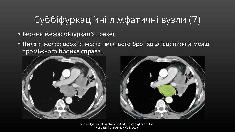 Суббіфуркаційні лімфатичні вузли (7) • Верхня межа: біфуркація трахеї. • Нижня межа: верхня межа