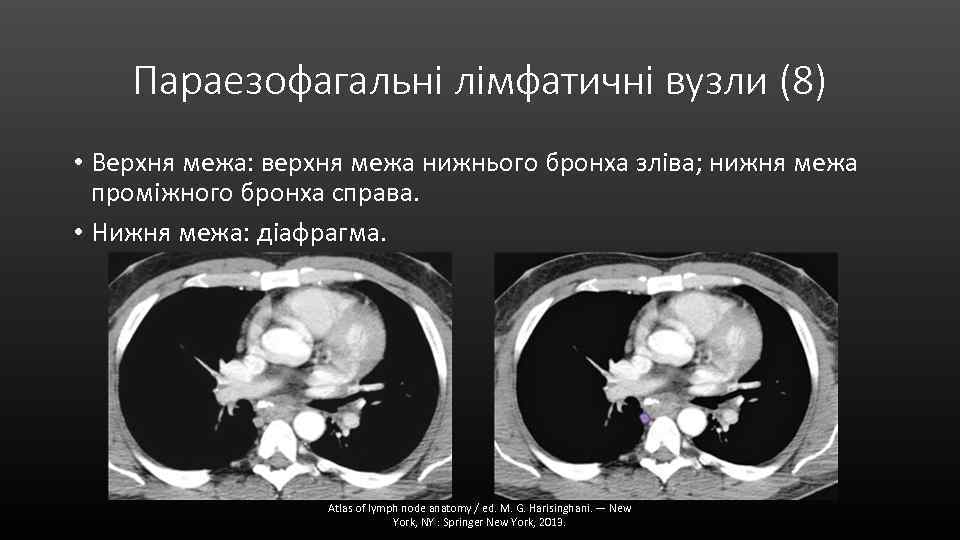 Параезофагальні лімфатичні вузли (8) • Верхня межа: верхня межа нижнього бронха зліва; нижня межа