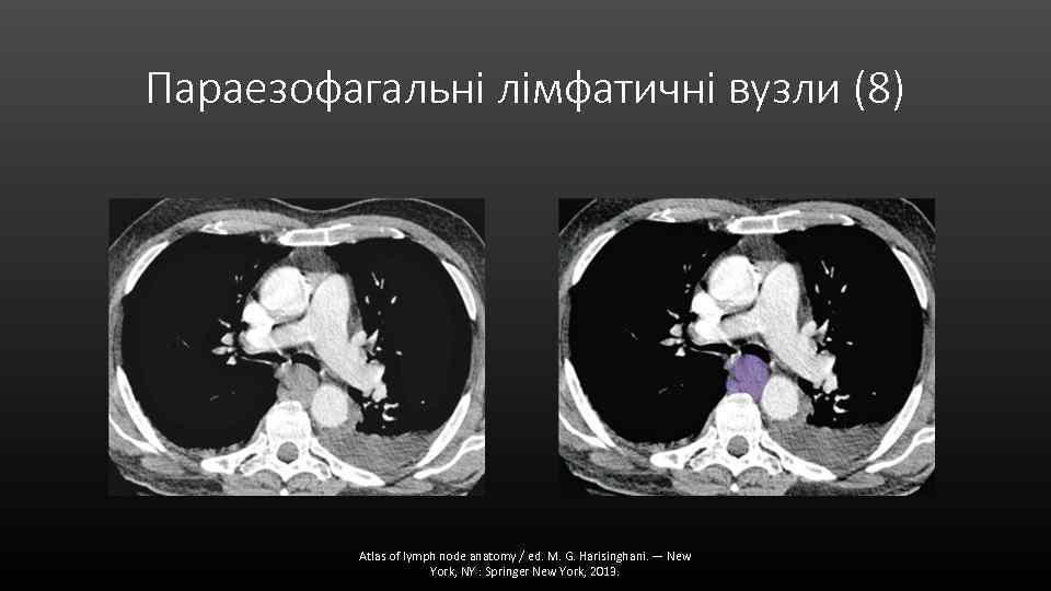 Параезофагальні лімфатичні вузли (8) Atlas of lymph node anatomy / ed. M. G. Harisinghani.