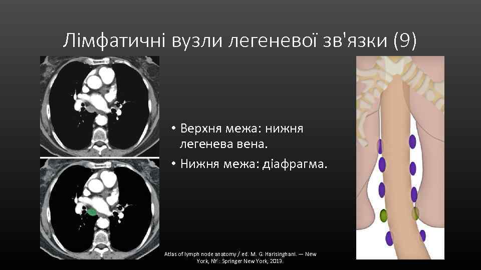 Лімфатичні вузли легеневої зв'язки (9) • Верхня межа: нижня легенева вена. • Нижня межа: